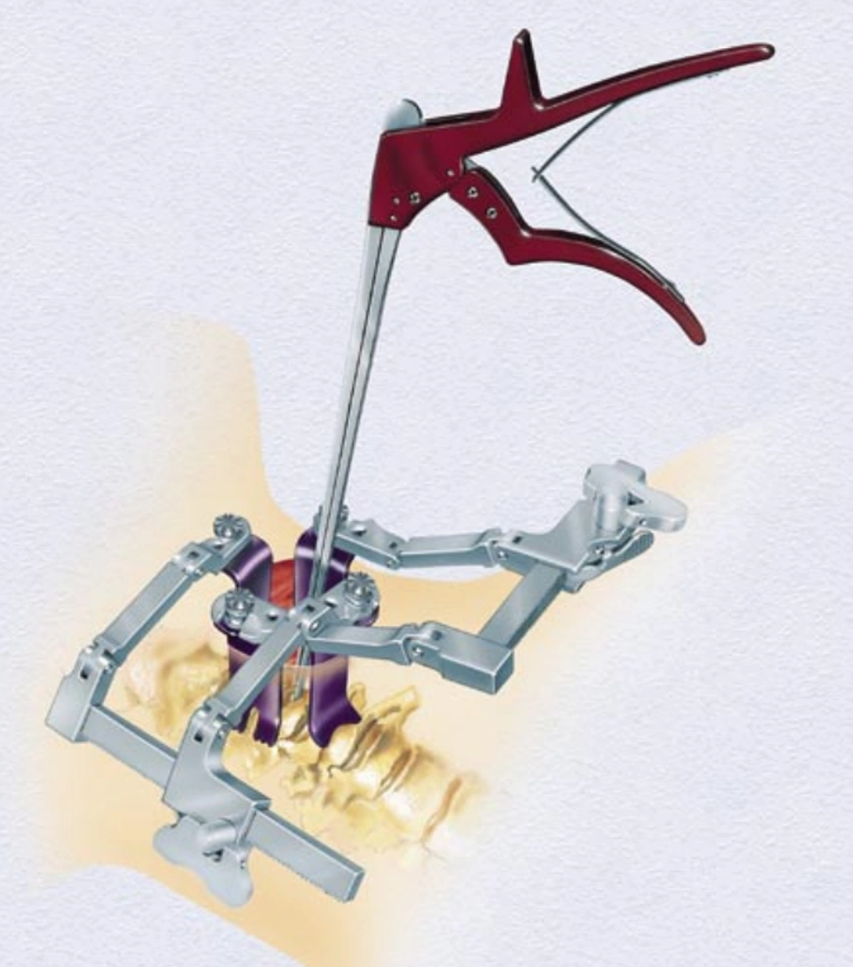 Trimline Retractor Surgical Diagram